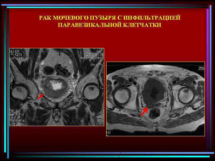 РАК МОЧЕВОГО ПУЗЫРЯ С ИНФИЛЬТРАЦИЕЙ ПАРАВЕЗИКАЛЬНОЙ КЛЕТЧАТКИ 