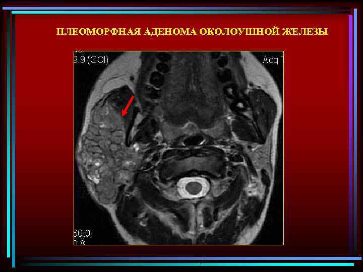 ПЛЕОМОРФНАЯ АДЕНОМА ОКОЛОУШНОЙ ЖЕЛЕЗЫ 