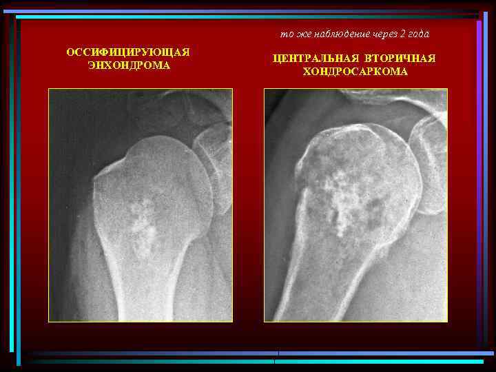 то же наблюдение через 2 года ОССИФИЦИРУЮЩАЯ ЭНХОНДРОМА ЦЕНТРАЛЬНАЯ ВТОРИЧНАЯ ХОНДРОСАРКОМА 
