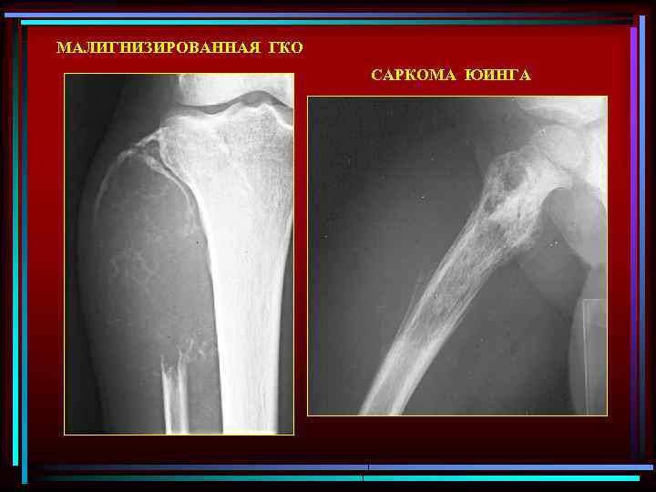 МАЛИГНИЗИРОВАННАЯ ГКО САРКОМА ЮИНГА 