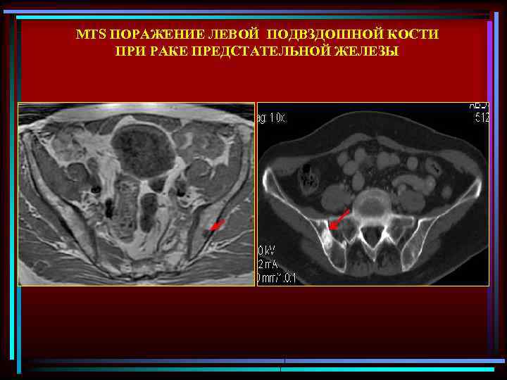 MTS ПОРАЖЕНИЕ ЛЕВОЙ ПОДВЗДОШНОЙ КОСТИ ПРИ РАКЕ ПРЕДСТАТЕЛЬНОЙ ЖЕЛЕЗЫ 