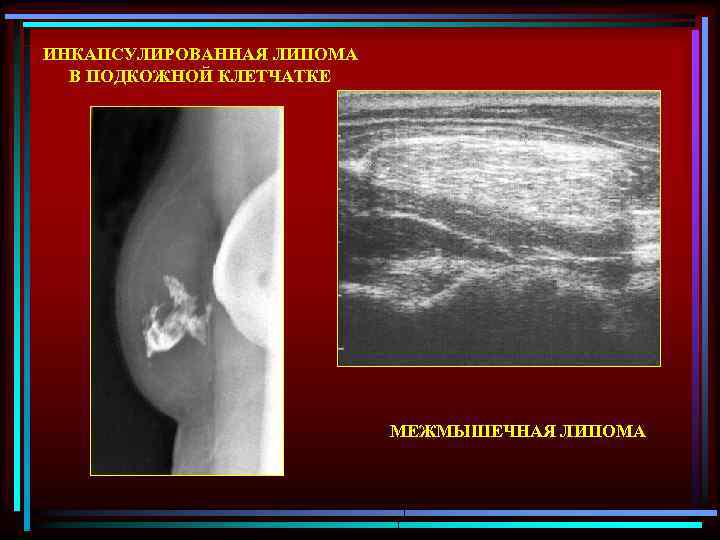 ИНКАПСУЛИРОВАННАЯ ЛИПОМА В ПОДКОЖНОЙ КЛЕТЧАТКЕ МЕЖМЫШЕЧНАЯ ЛИПОМА 