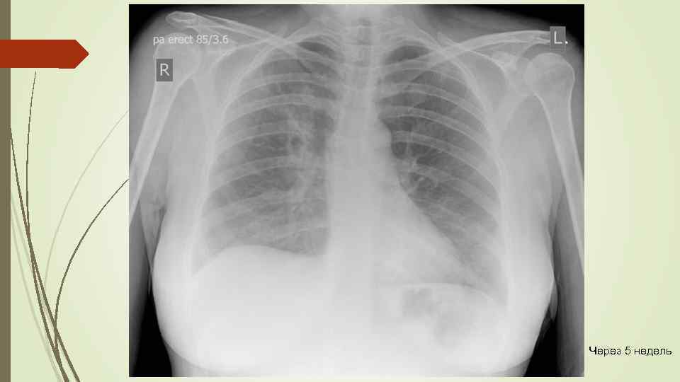 Через 5 недель 