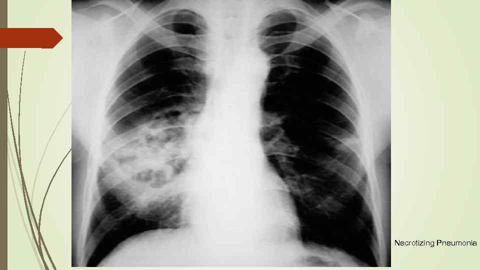 Necrotizing Pneumonia 