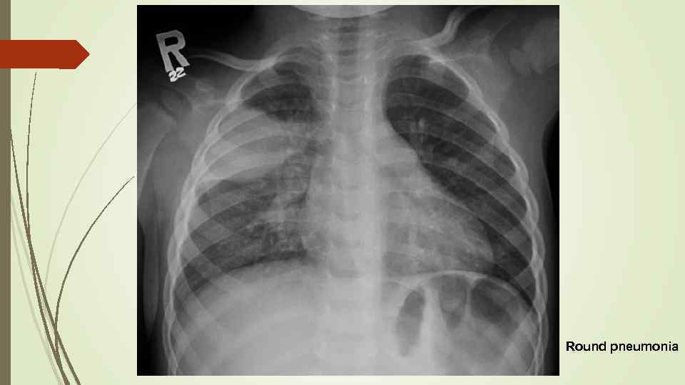 Round pneumonia 