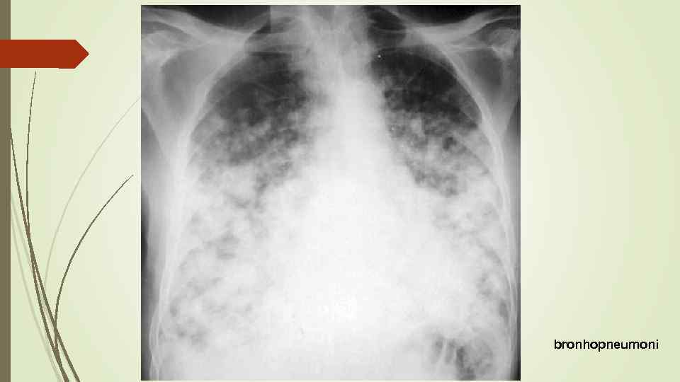 bronhopneumoni 