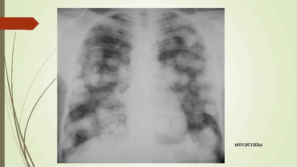 метастазы 