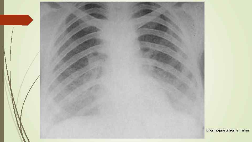 bronhopneumonie miliar 