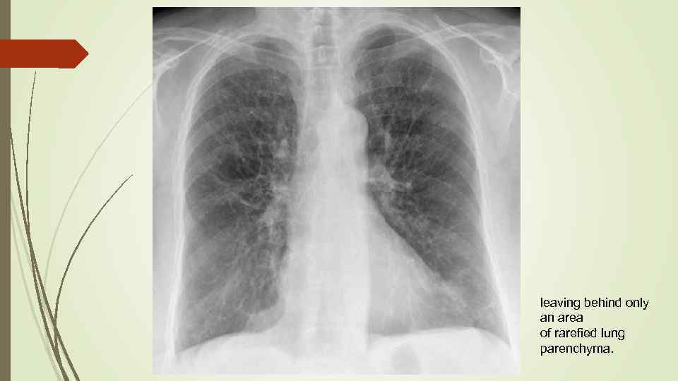 leaving behind only an area of rarefied lung parenchyma. 