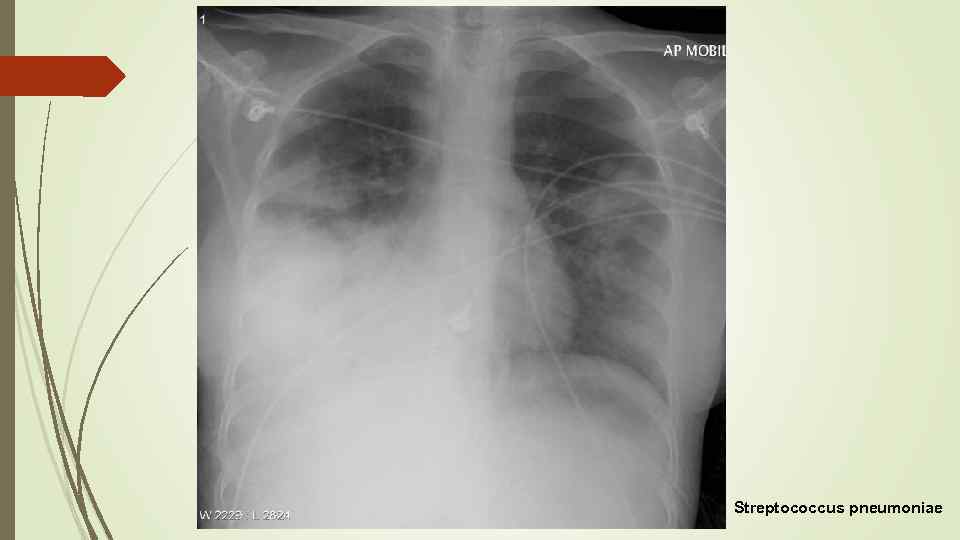Streptococcus pneumoniae 