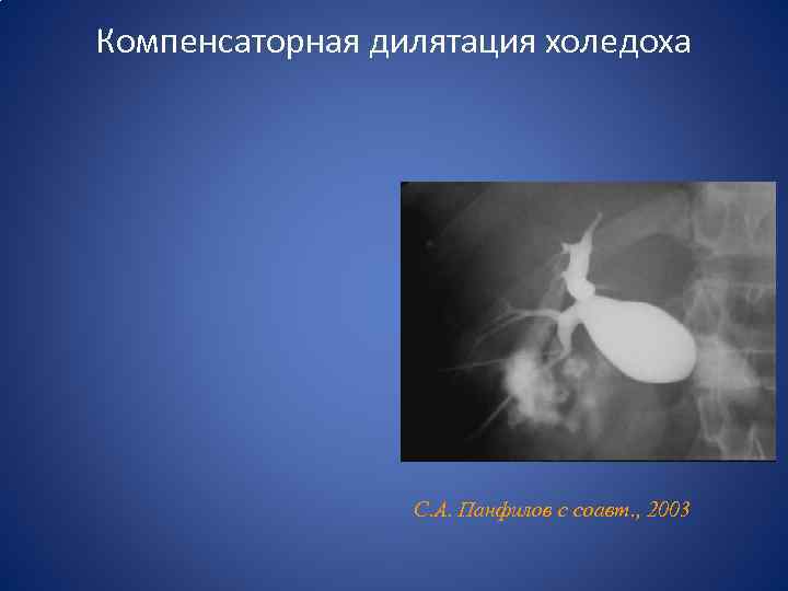 Компенсаторная дилятация холедоха С. А. Панфилов с соавт. , 2003 