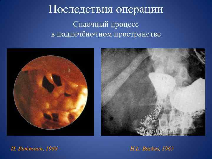 Последствия операции Спаечный процесс в подпечёночном пространстве И. Виттман, 1966 H. L. Bockus, 1965