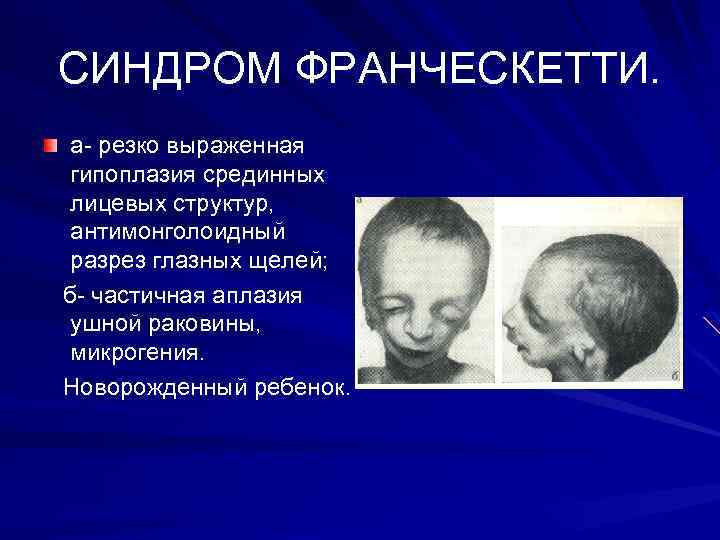 СИНДРОМ ФРАНЧЕСКЕТТИ. а- резко выраженная гипоплазия срединных лицевых структур, антимонголоидный разрез глазных щелей; б-