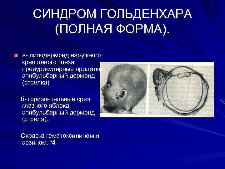 СИНДРОМ ГОЛЬДЕНХАРА (ПОЛНАЯ ФОРМА). а- липодермоид наружного края левого глаза, преаурикулярные придатки, эпибульбарный дермоид