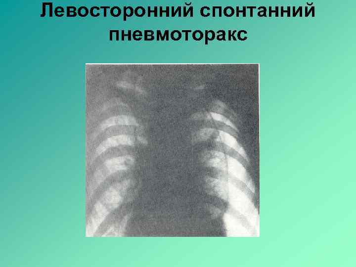 Левосторонний спонтанний пневмоторакс 