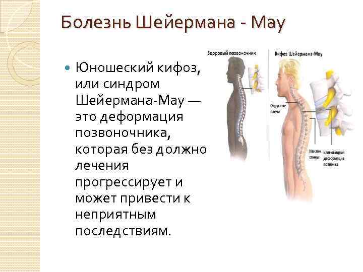 Болезнь Шейермана - Мау Юношеский кифоз, или синдром Шейермана-Мау — это деформация позвоночника, которая