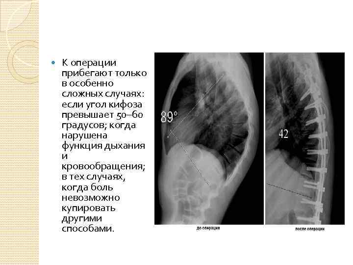  К операции прибегают только в особенно сложных случаях: если угол кифоза превышает 50–