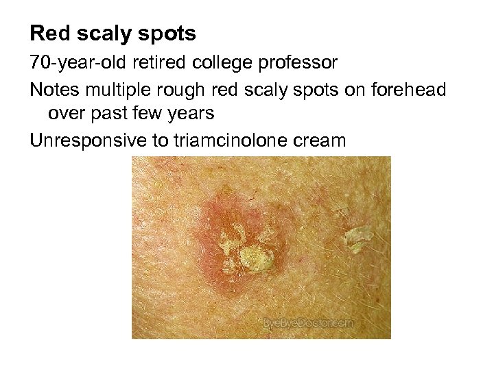 Red scaly spots 70 -year-old retired college professor Notes multiple rough red scaly spots