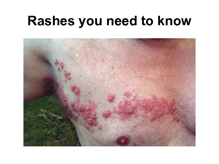 Rashes you need to know 