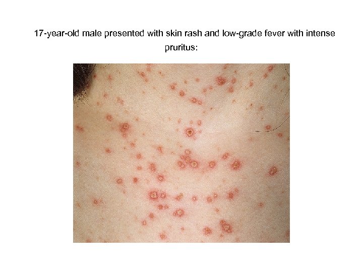 17 -year-old male presented with skin rash and low-grade fever with intense pruritus: 