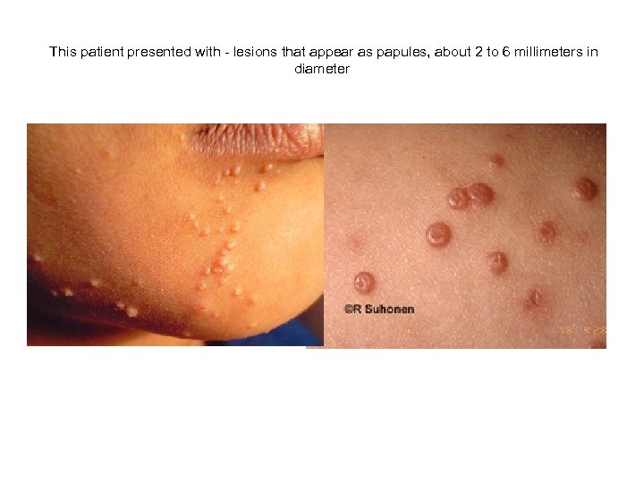 This patient presented with - lesions that appear as papules, about 2 to 6