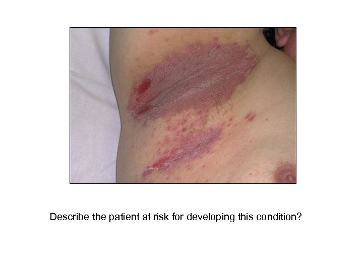 Describe the patient at risk for developing this condition? 