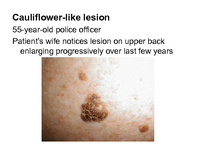 Cauliflower-like lesion 55 -year-old police officer Patient’s wife notices lesion on upper back enlarging