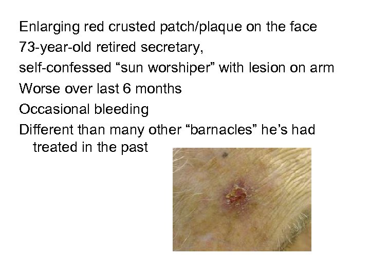 Enlarging red crusted patch/plaque on the face 73 -year-old retired secretary, self-confessed “sun worshiper”