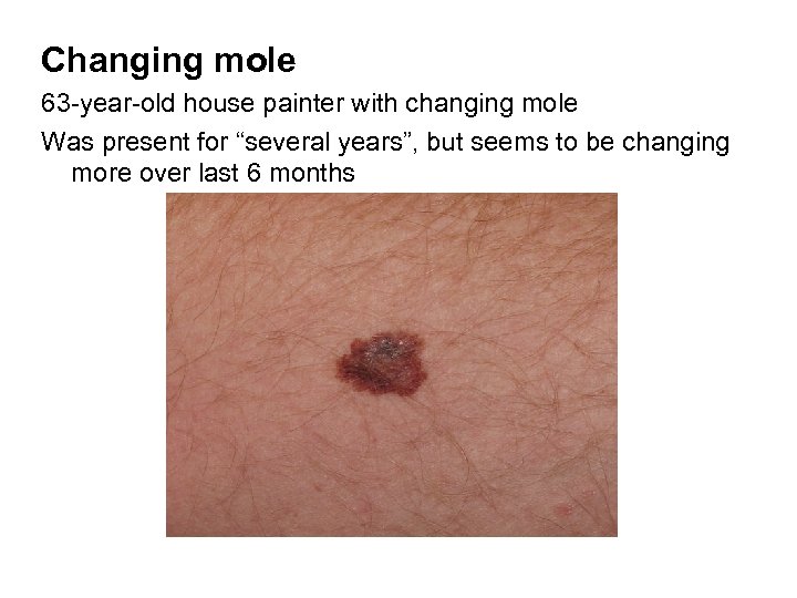 Changing mole 63 -year-old house painter with changing mole Was present for “several years”,