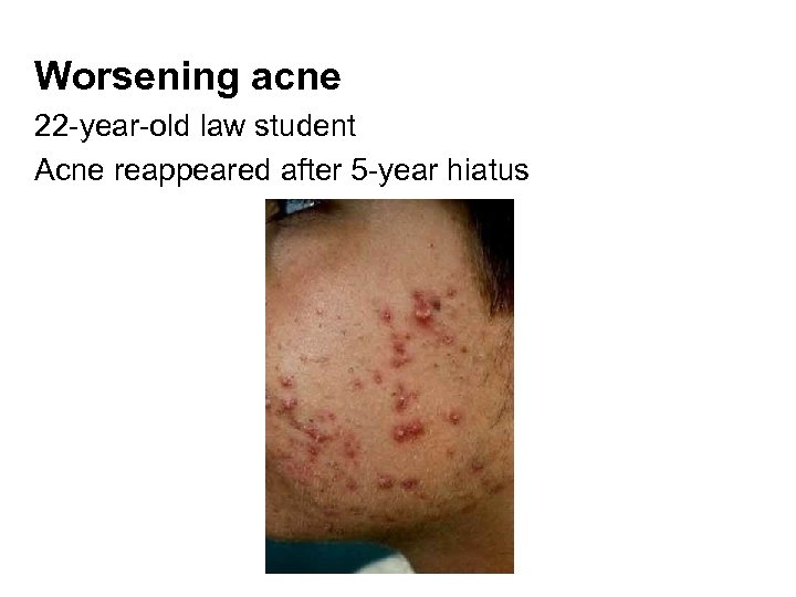 Worsening acne 22 -year-old law student Acne reappeared after 5 -year hiatus 