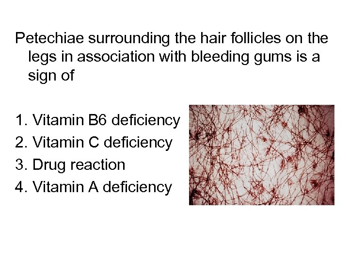 Petechiae surrounding the hair follicles on the legs in association with bleeding gums is