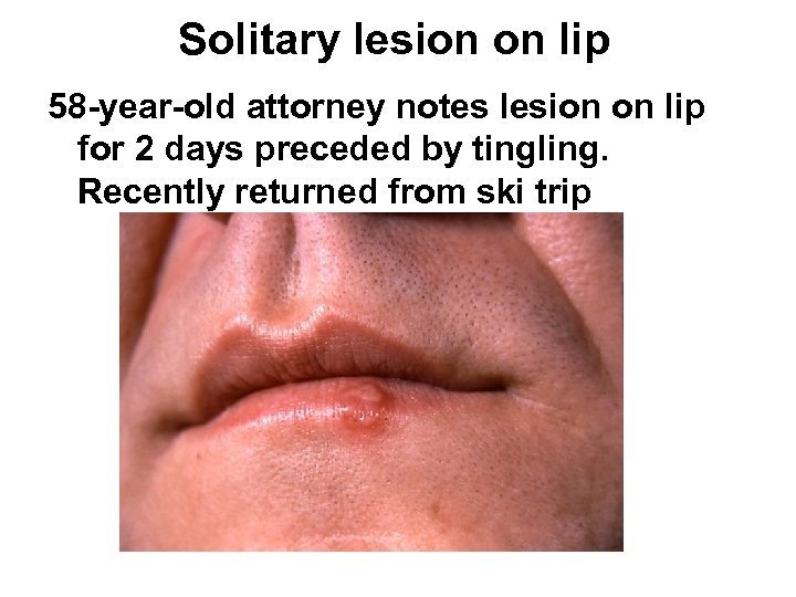 Solitary lesion on lip 58 -year-old attorney notes lesion on lip for 2 days