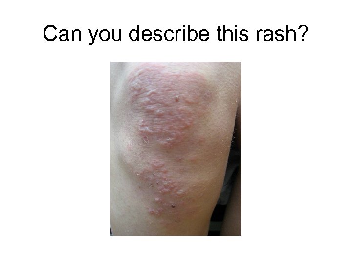 Can you describe this rash? 