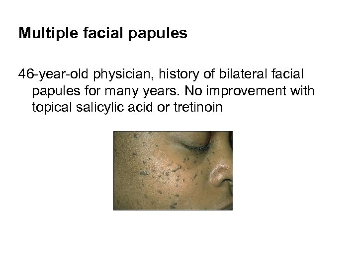 Multiple facial papules 46 -year-old physician, history of bilateral facial papules for many years.