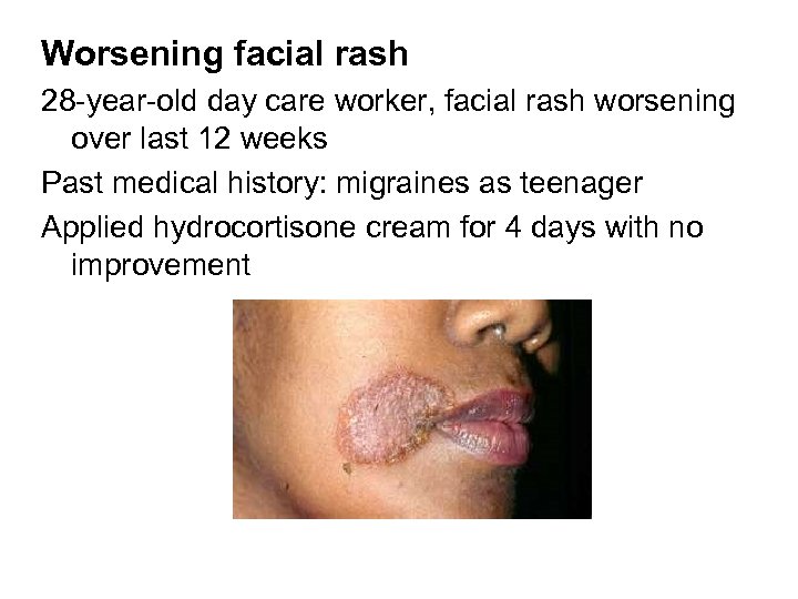 Worsening facial rash 28 -year-old day care worker, facial rash worsening over last 12