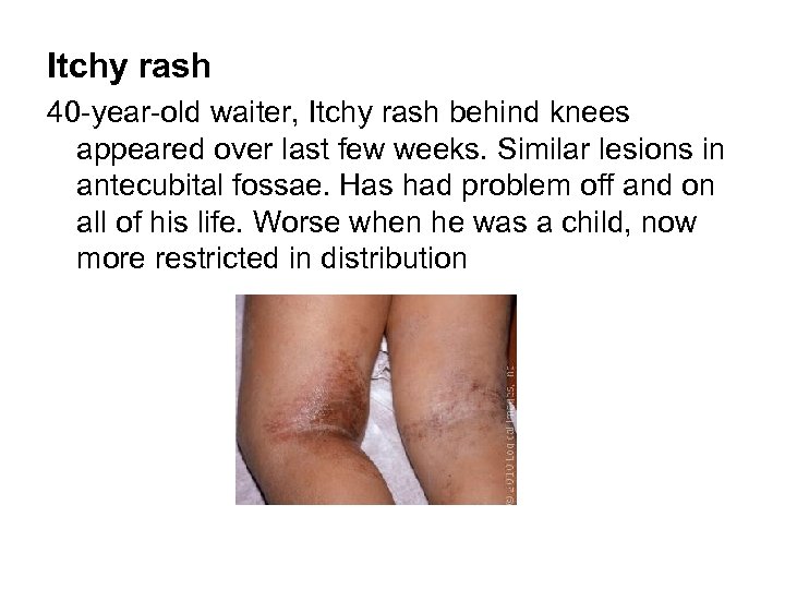 Itchy rash 40 -year-old waiter, Itchy rash behind knees appeared over last few weeks.