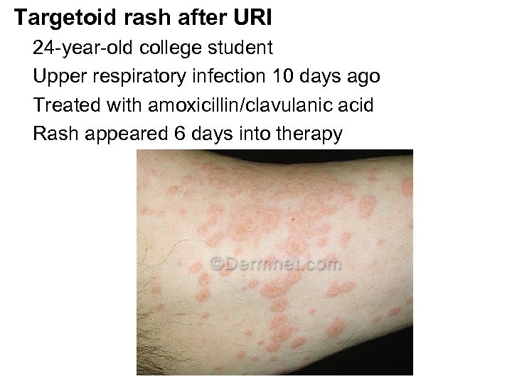 Targetoid rash after URI 24 -year-old college student Upper respiratory infection 10 days ago