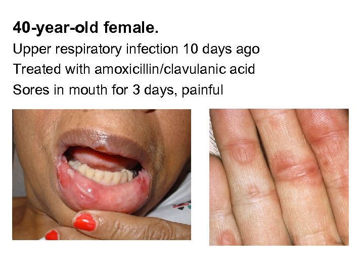 40 -year-old female. Upper respiratory infection 10 days ago Treated with amoxicillin/clavulanic acid Sores