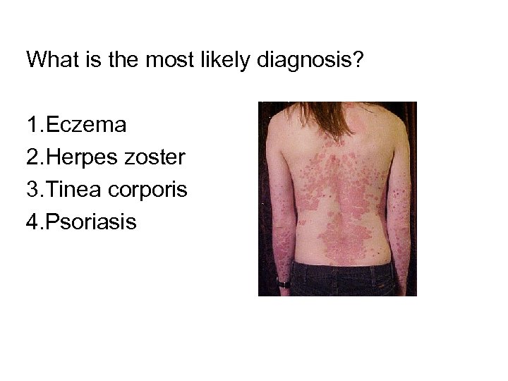 What is the most likely diagnosis? 1. Eczema 2. Herpes zoster 3. Tinea corporis