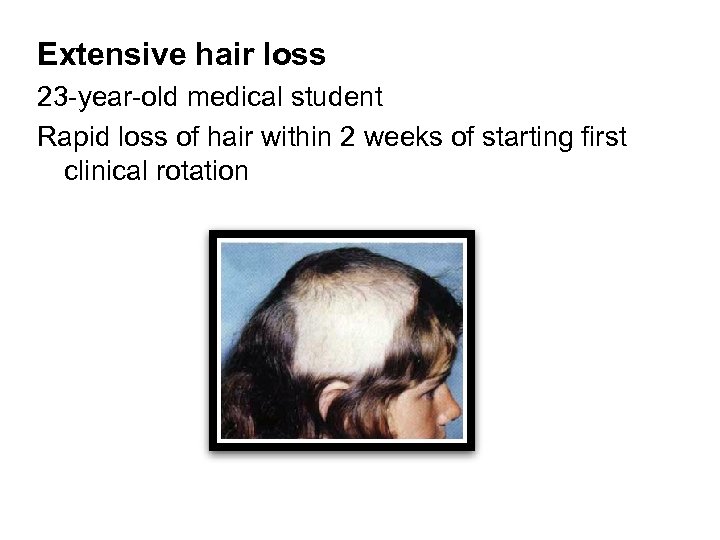 Extensive hair loss 23 -year-old medical student Rapid loss of hair within 2 weeks