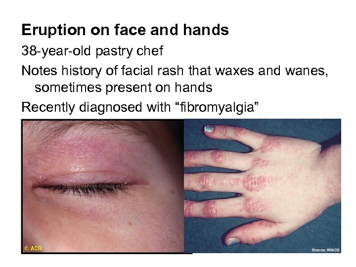 Eruption on face and hands 38 -year-old pastry chef Notes history of facial rash