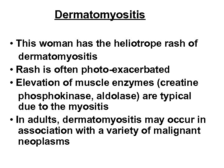 Dermatomyositis • This woman has the heliotrope rash of dermatomyositis • Rash is often