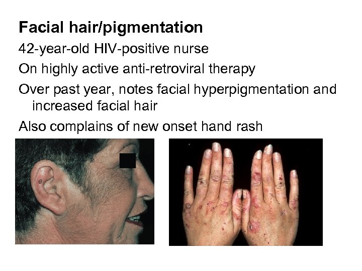 Facial hair/pigmentation 42 -year-old HIV-positive nurse On highly active anti-retroviral therapy Over past year,