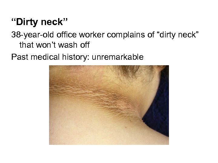 “Dirty neck” 38 -year-old office worker complains of “dirty neck” that won’t wash off