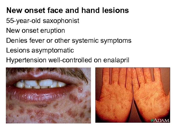 New onset face and hand lesions 55 -year-old saxophonist New onset eruption Denies fever