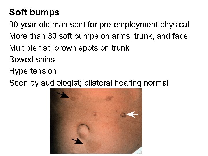 Soft bumps 30 -year-old man sent for pre-employment physical More than 30 soft bumps