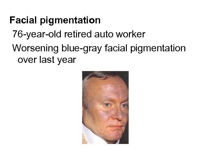 Facial pigmentation 76 -year-old retired auto worker Worsening blue-gray facial pigmentation over last year