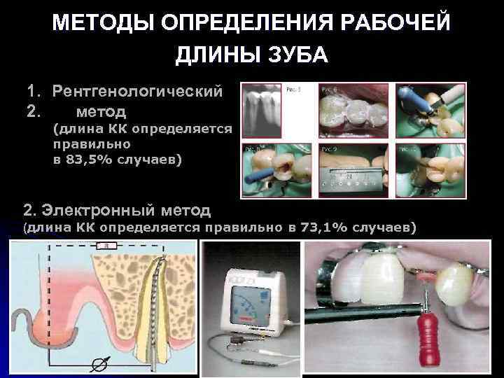 Методы пломбирования корневых каналов презентация