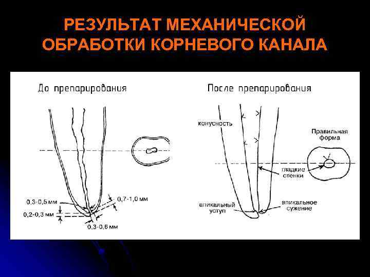 Машинная обработка корневых каналов