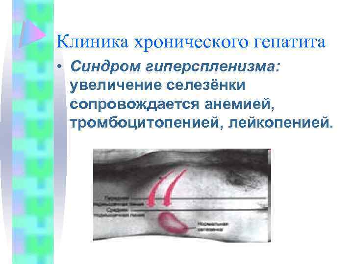 Клиника хронического гепатита • Синдром гиперспленизма: увеличение селезёнки сопровождается анемией, тромбоцитопенией, лейкопенией. 